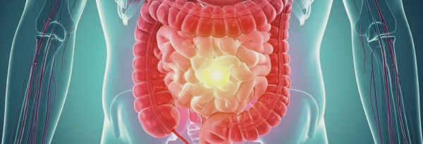 instestino pinchado, disbiosis